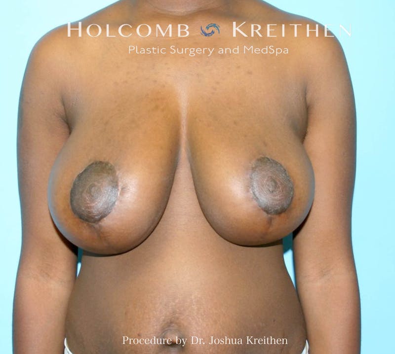 Breast Reduction Before & After Gallery - Patient 711722 - Image 2