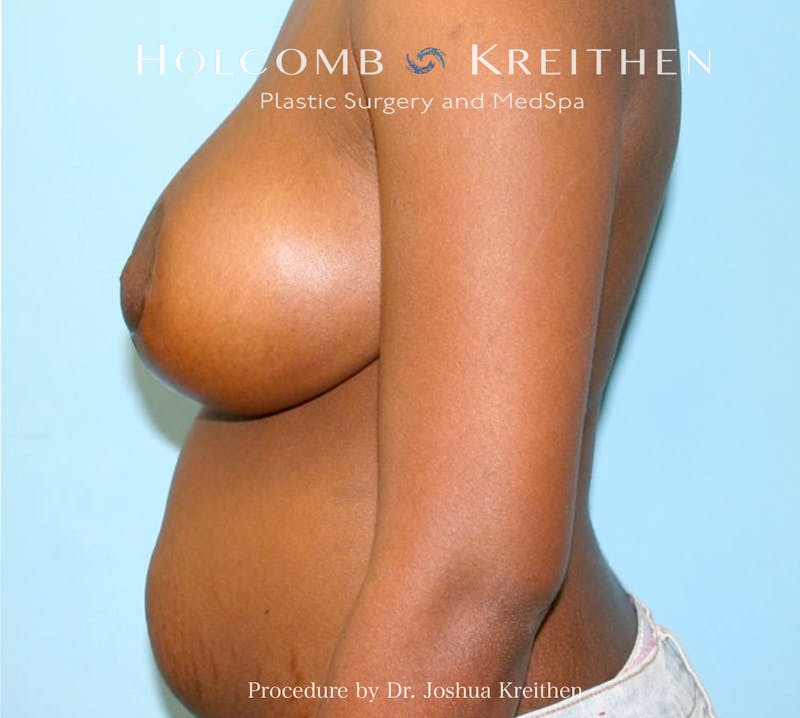 Breast Reduction Before & After Gallery - Patient 711722 - Image 6