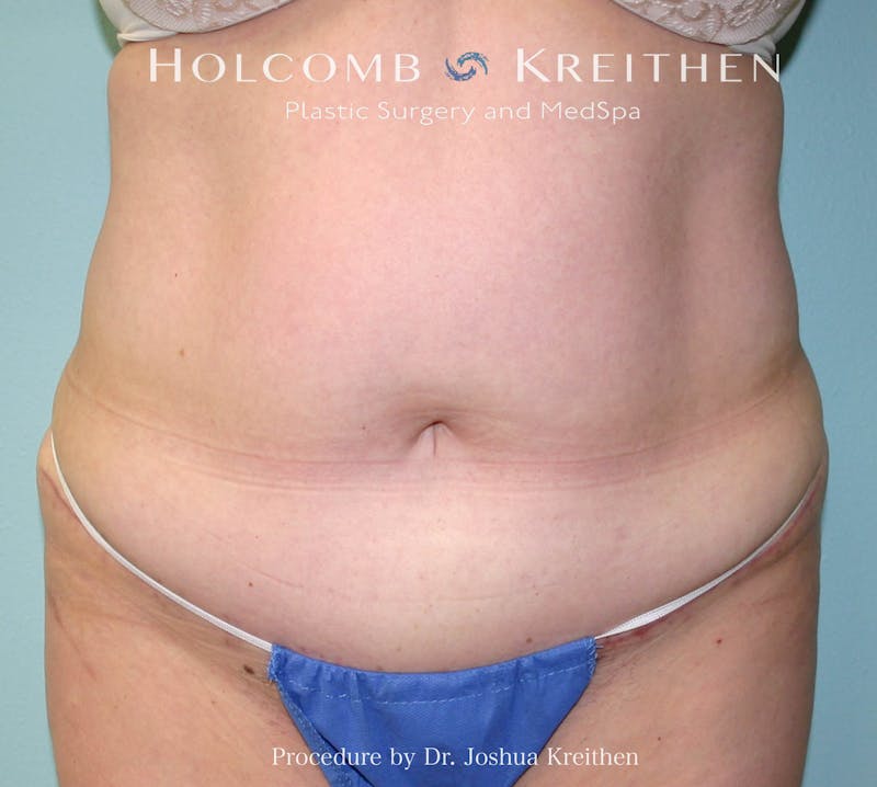 Mini Abdominoplasty Before & After Gallery - Patient 307504 - Image 2