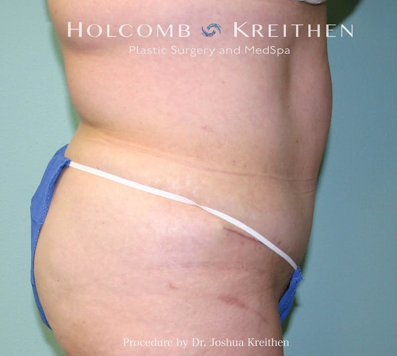 Mini Abdominoplasty Before & After Gallery - Patient 307504 - Image 4