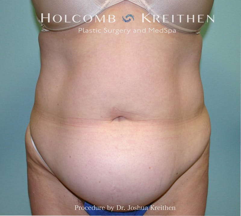 Mini Abdominoplasty Before & After Gallery - Patient 307504 - Image 1