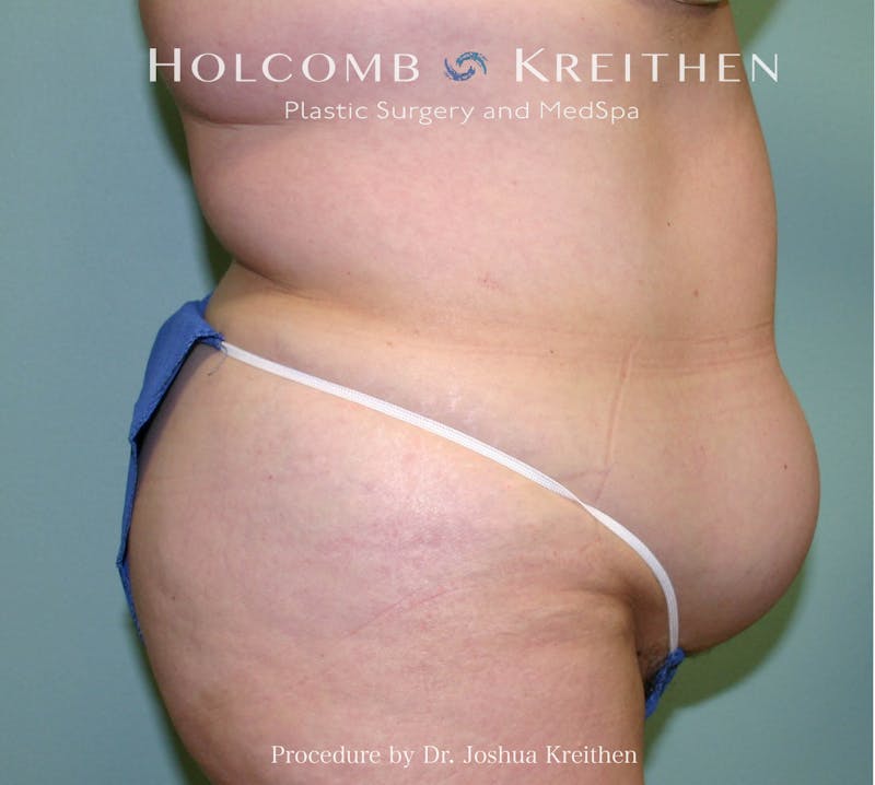 Mini Abdominoplasty Before & After Gallery - Patient 307504 - Image 3