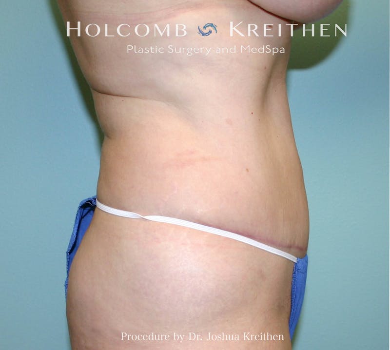 Mini Abdominoplasty Before & After Gallery - Patient 393864 - Image 4