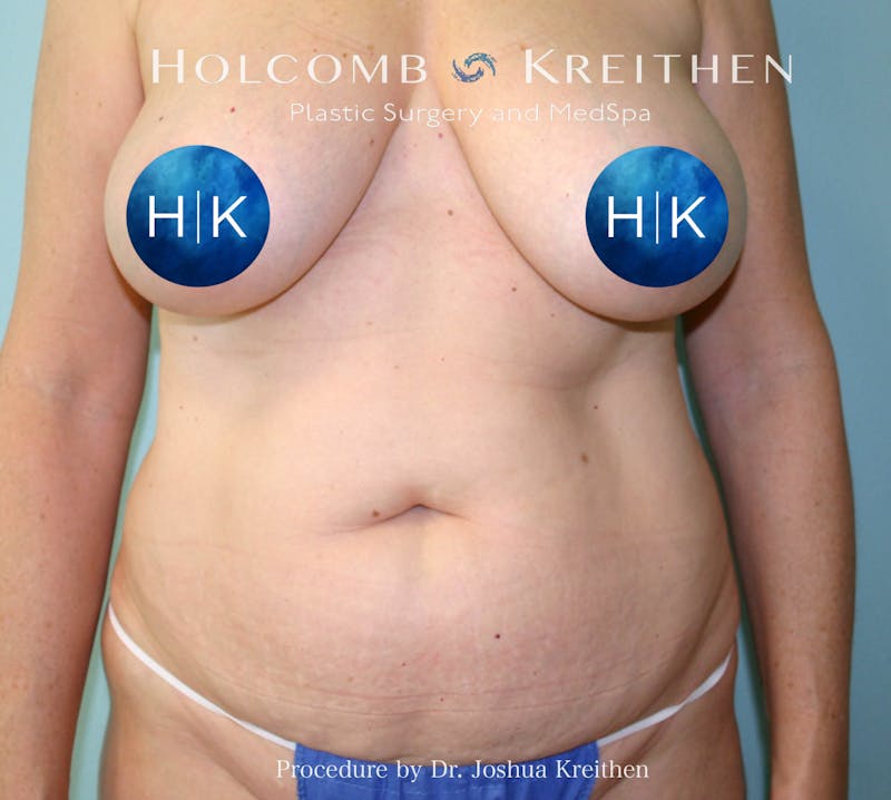 Mini Abdominoplasty Before & After Gallery - Patient 393864 - Image 1