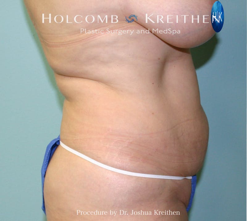 Mini Abdominoplasty Before & After Gallery - Patient 393864 - Image 3