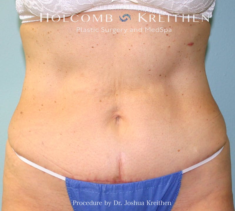 Mini Abdominoplasty Before & After Gallery - Patient 185980 - Image 2