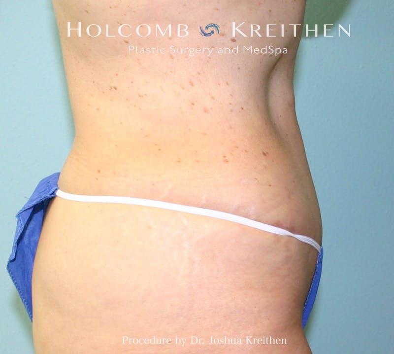 Mini Abdominoplasty Before & After Gallery - Patient 185980 - Image 4