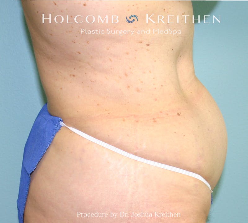 Mini Abdominoplasty Before & After Gallery - Patient 185980 - Image 3