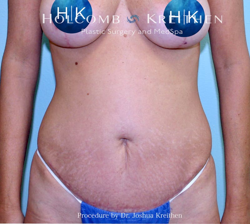 Mini Abdominoplasty Before & After Gallery - Patient 184429 - Image 2