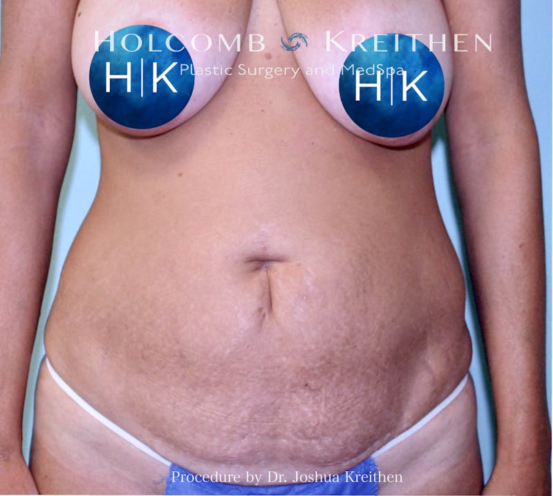 Mini Abdominoplasty Before & After Gallery - Patient 184429 - Image 1