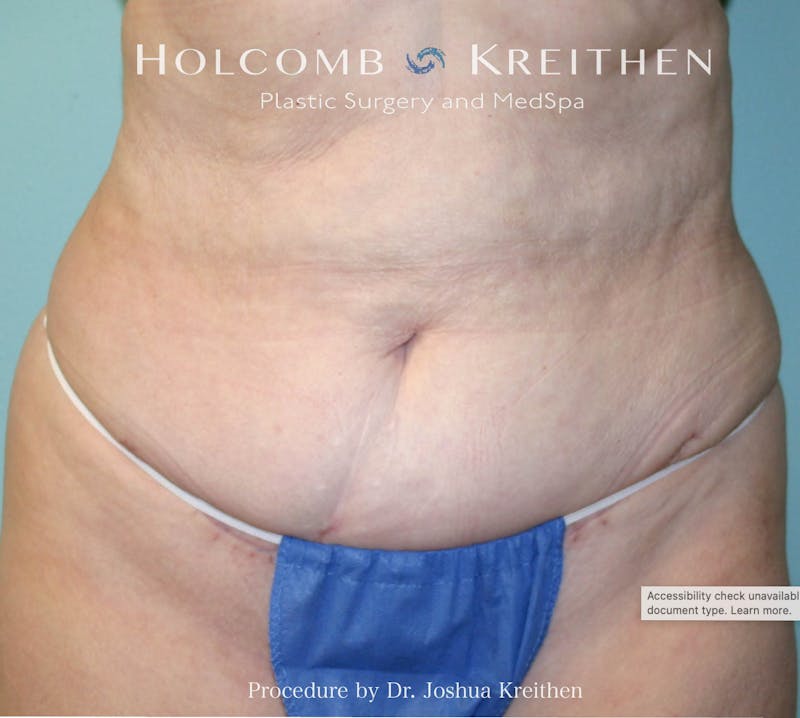 Mini Abdominoplasty Before & After Gallery - Patient 357051 - Image 2