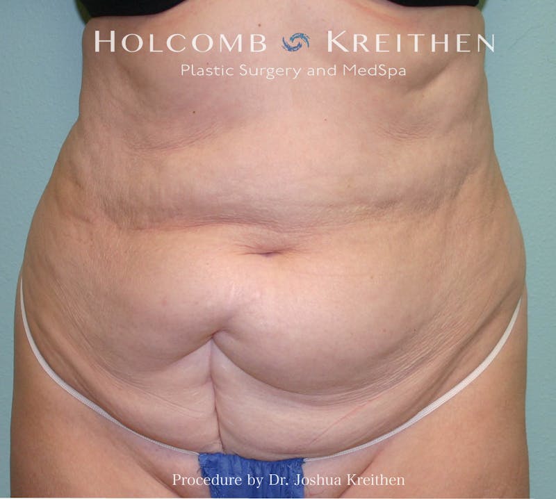 Mini Abdominoplasty Before & After Gallery - Patient 357051 - Image 1