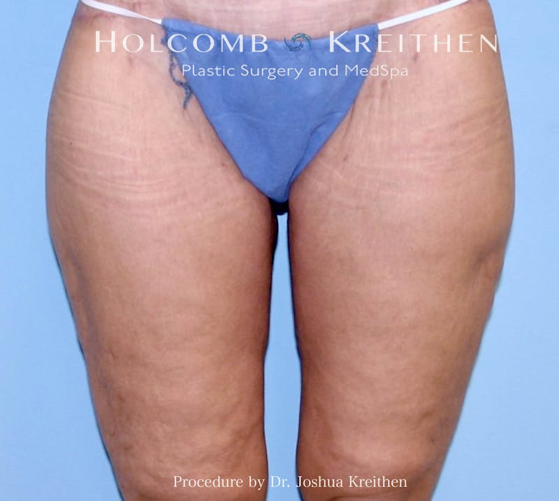 Thigh Lift Before & After Gallery - Patient 307907 - Image 2