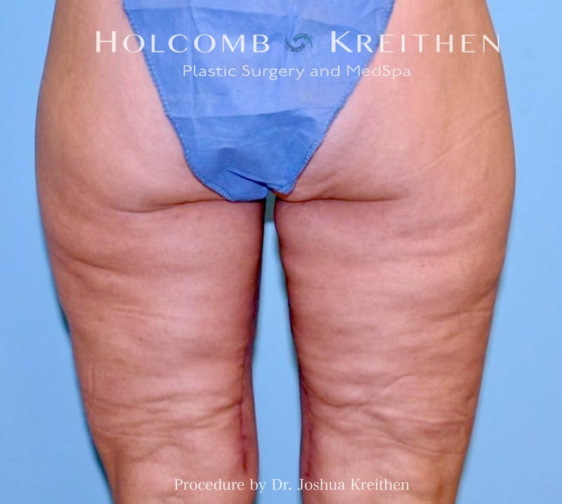 Thigh Lift Before & After Gallery - Patient 307907 - Image 4