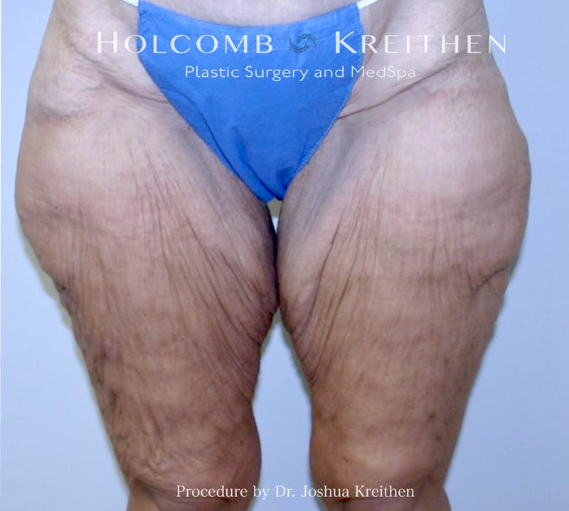 Thigh Lift Before & After Gallery - Patient 307907 - Image 1