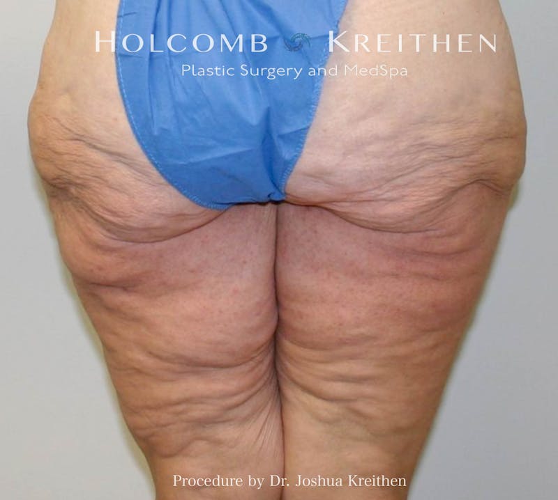 Thigh Lift Before & After Gallery - Patient 307907 - Image 3