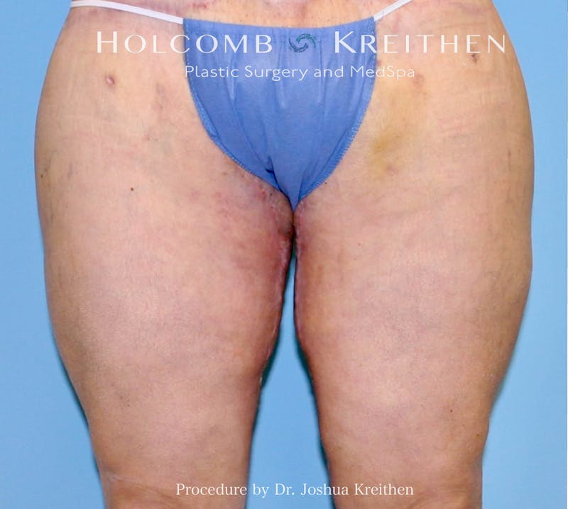 Thigh Lift Before & After Gallery - Patient 384200 - Image 2