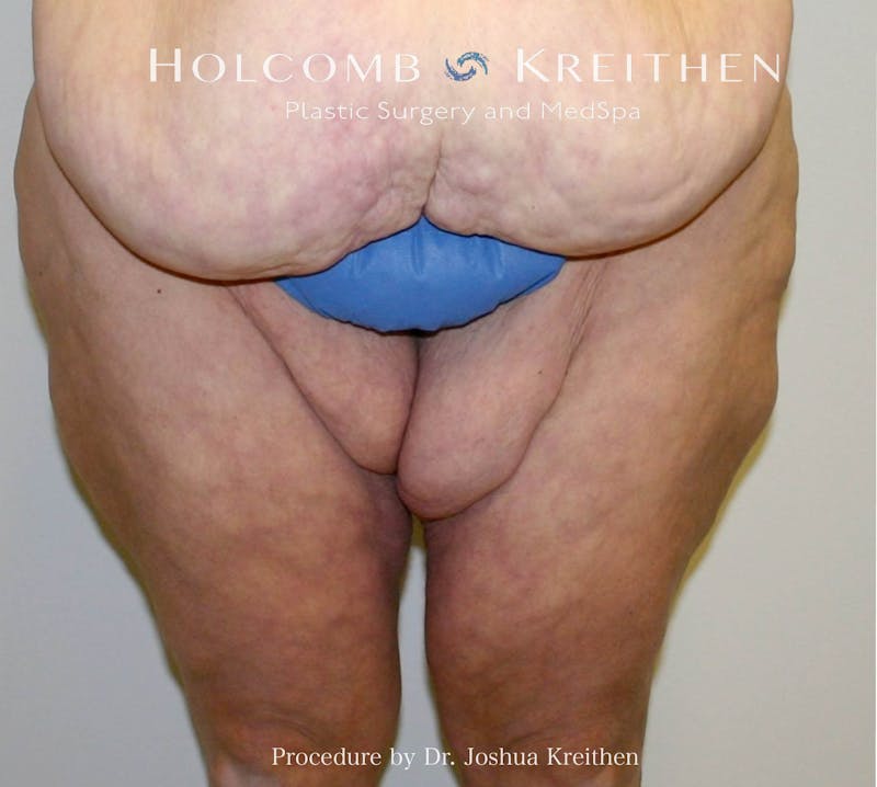 Thigh Lift Before & After Gallery - Patient 384200 - Image 1