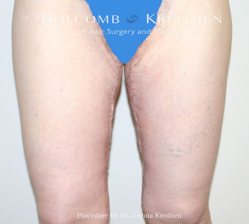 Thigh Lift Before & After Gallery - Patient 186258 - Image 2