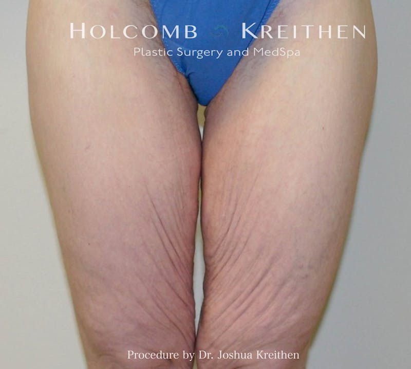Thigh Lift Before & After Gallery - Patient 186258 - Image 1