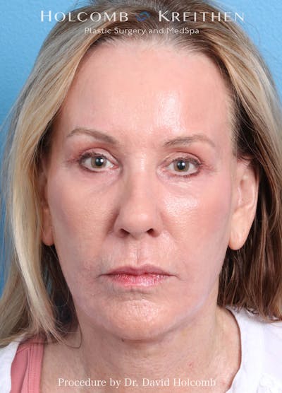 Ultraclear Before & After Gallery - Patient 365768 - Image 2