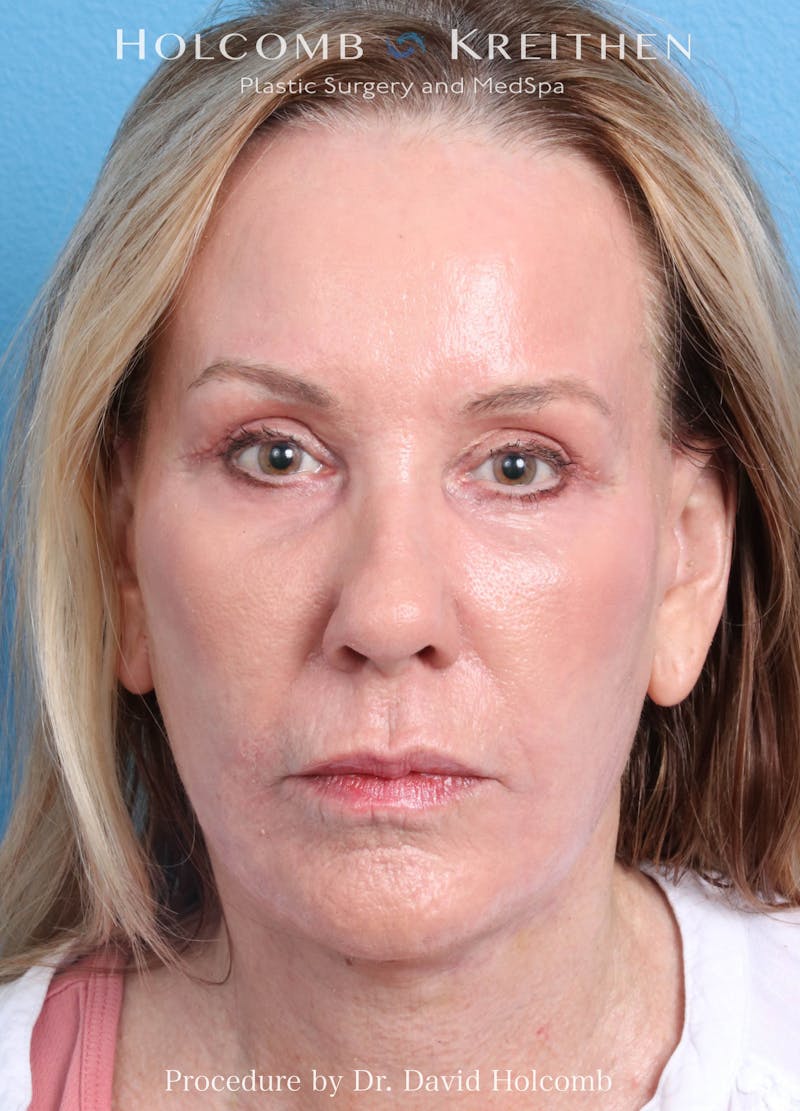 Ultraclear Before & After Gallery - Patient 365768 - Image 2
