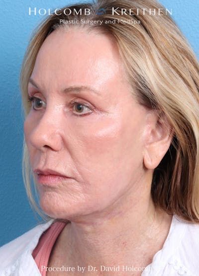 Ultraclear (Landing) Before & After Gallery - Patient 110925 - Image 2