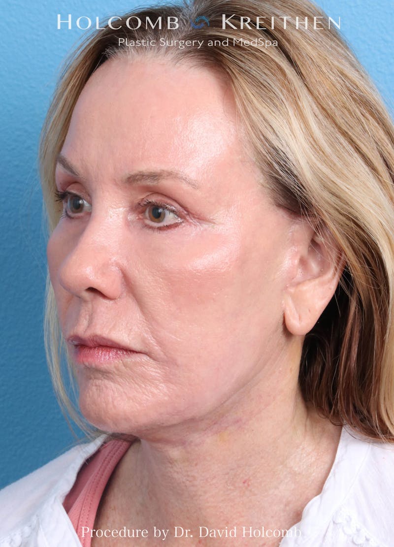 Ultraclear Before & After Gallery - Patient 365768 - Image 4