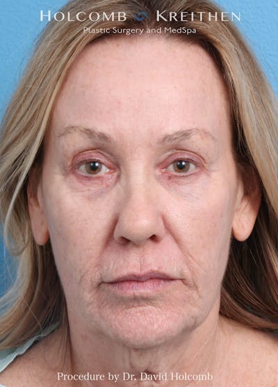 Ultraclear Before & After Gallery - Patient 365768 - Image 1