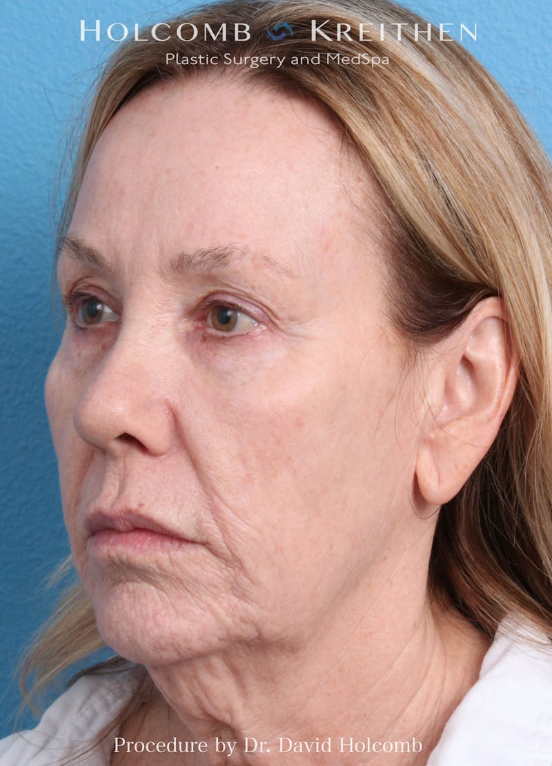 Ultraclear Before & After Gallery - Patient 365768 - Image 3