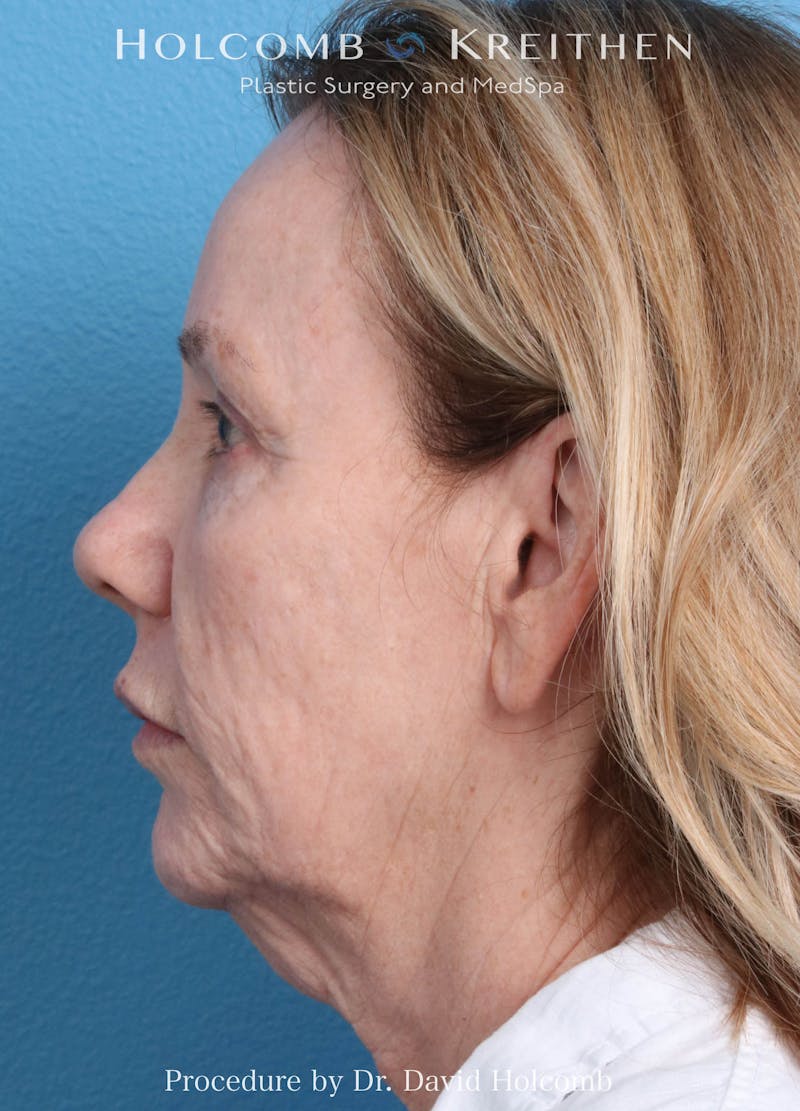 Ultraclear Before & After Gallery - Patient 365768 - Image 5