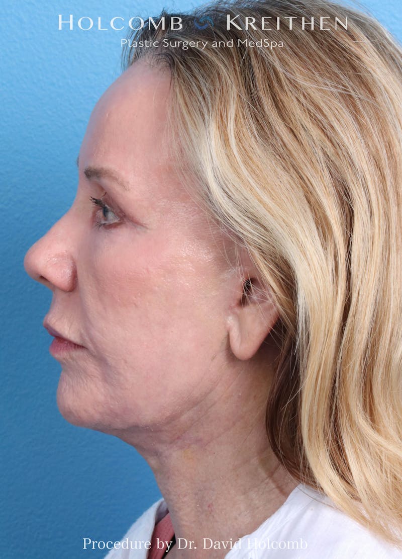 Ultraclear Before & After Gallery - Patient 365768 - Image 6