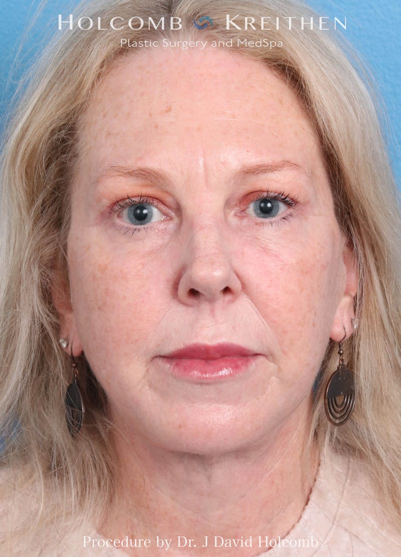 Facelift Before & After Gallery - Patient 221050 - Image 2