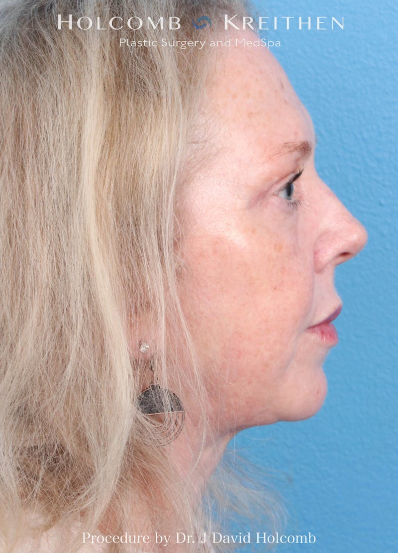 Facelift Before & After Gallery - Patient 221050 - Image 4