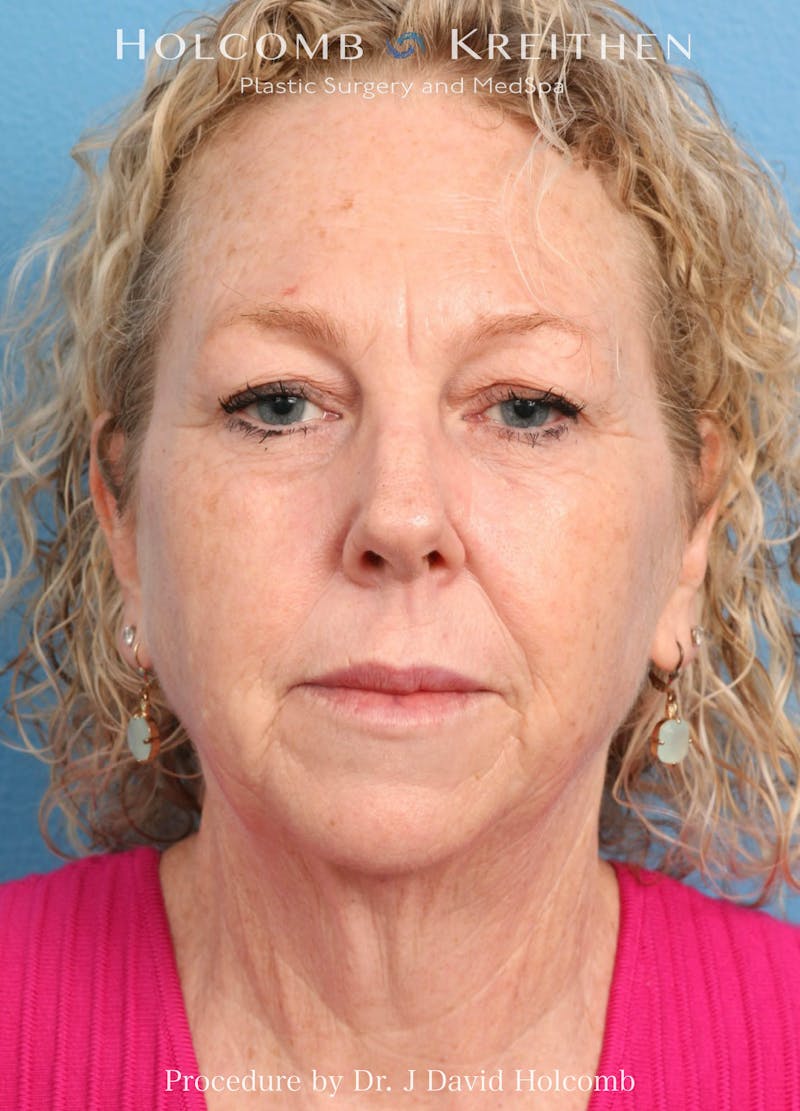 Facelift Before & After Gallery - Patient 221050 - Image 1