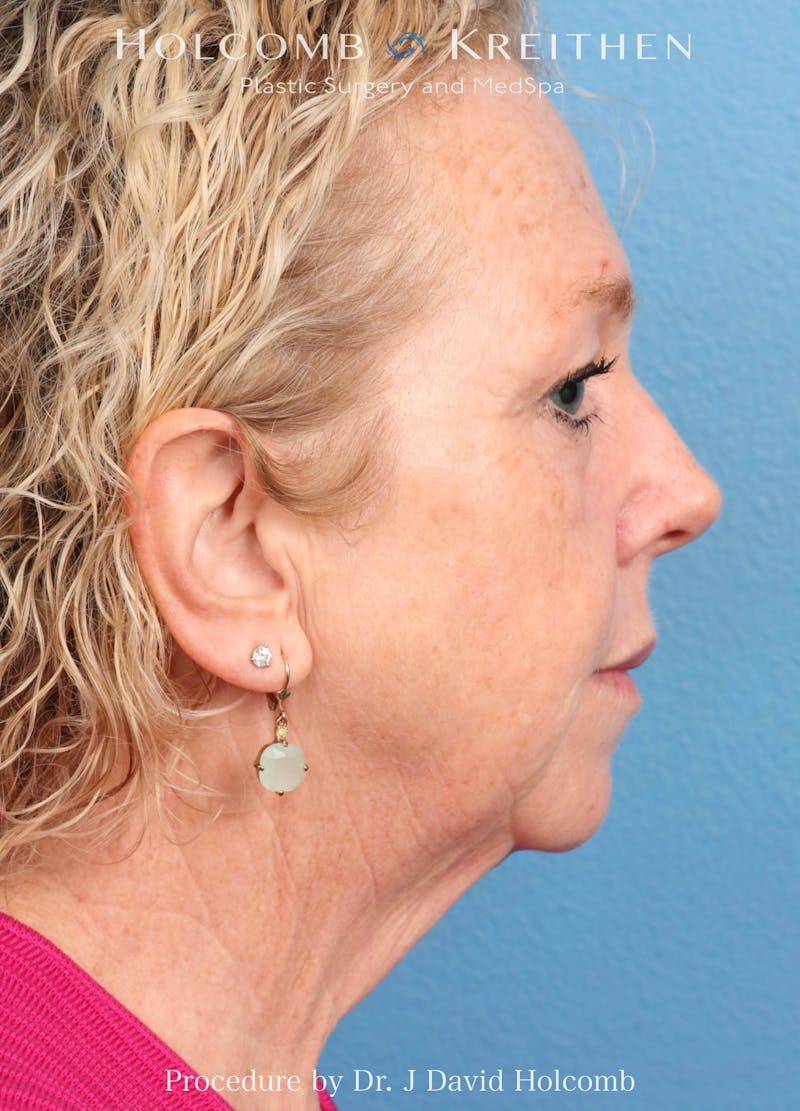 Facelift Before & After Gallery - Patient 221050 - Image 3