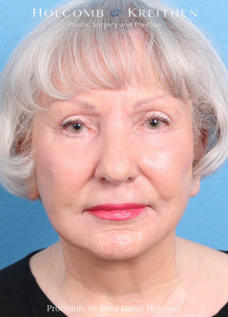 Morpheus  Before & After Gallery - Patient 306490 - Image 2