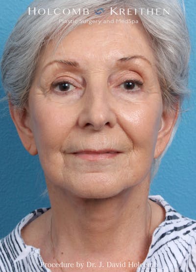 Facelift Before & After Gallery - Patient 564333 - Image 2