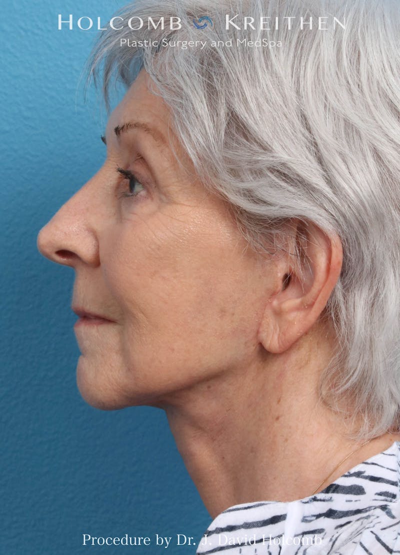 Facelift Before & After Gallery - Patient 564333 - Image 4