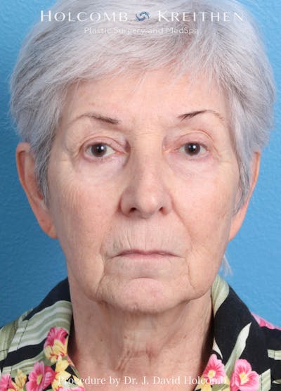 Facelift Before & After Gallery - Patient 564333 - Image 1