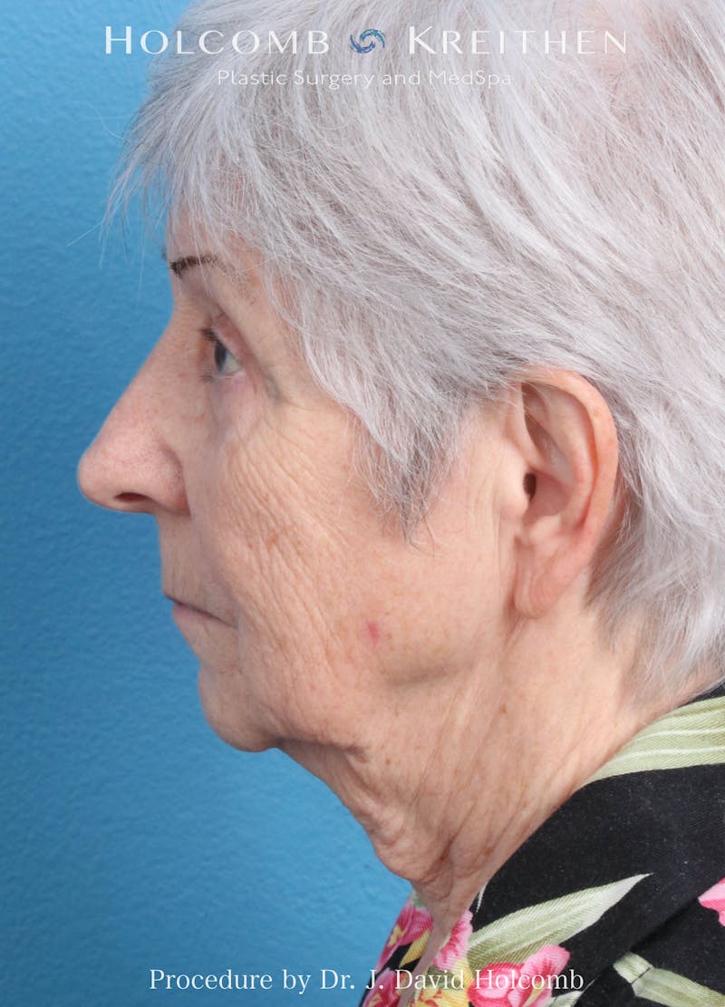 Facelift Before & After Gallery - Patient 564333 - Image 3