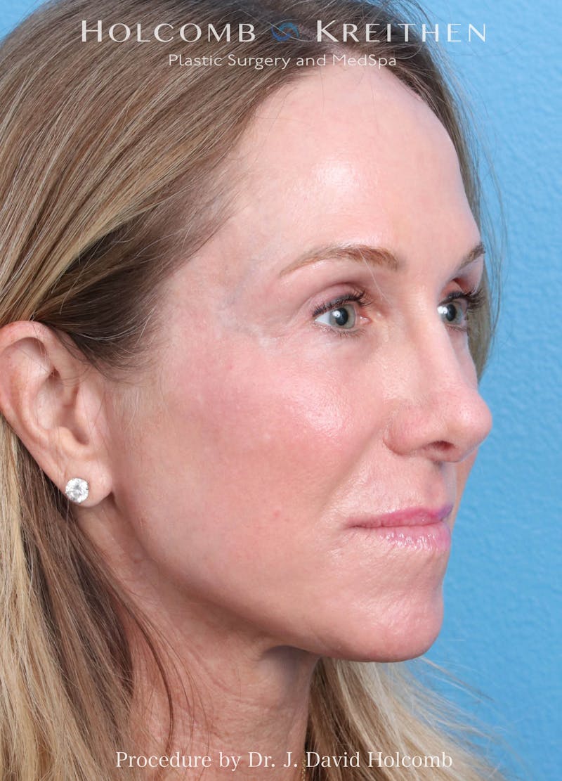 Ultraclear Before & After Gallery - Patient 127657 - Image 4