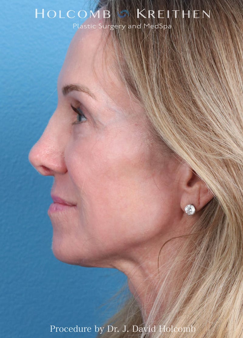 Ultraclear Before & After Gallery - Patient 127657 - Image 6