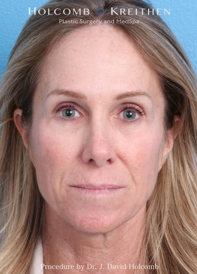 Ultraclear Before & After Gallery - Patient 127657 - Image 1