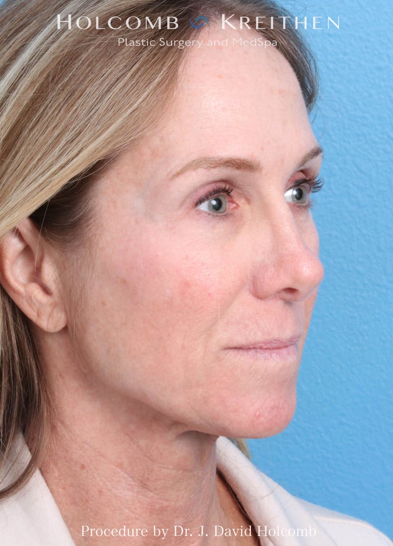 Ultraclear Before & After Gallery - Patient 127657 - Image 3