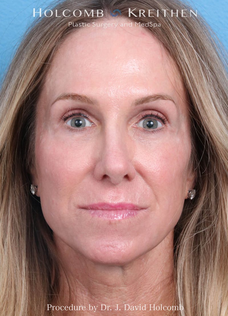 Ultraclear Before & After Gallery - Patient 127657 - Image 2