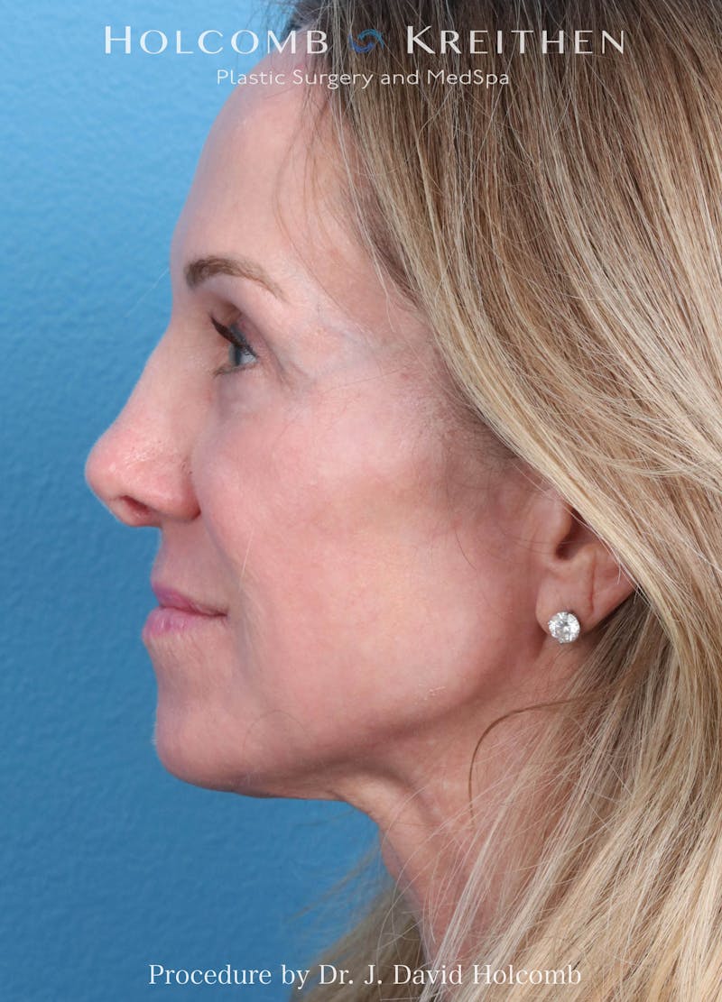 Ultraclear Before & After Gallery - Patient 127657 - Image 5