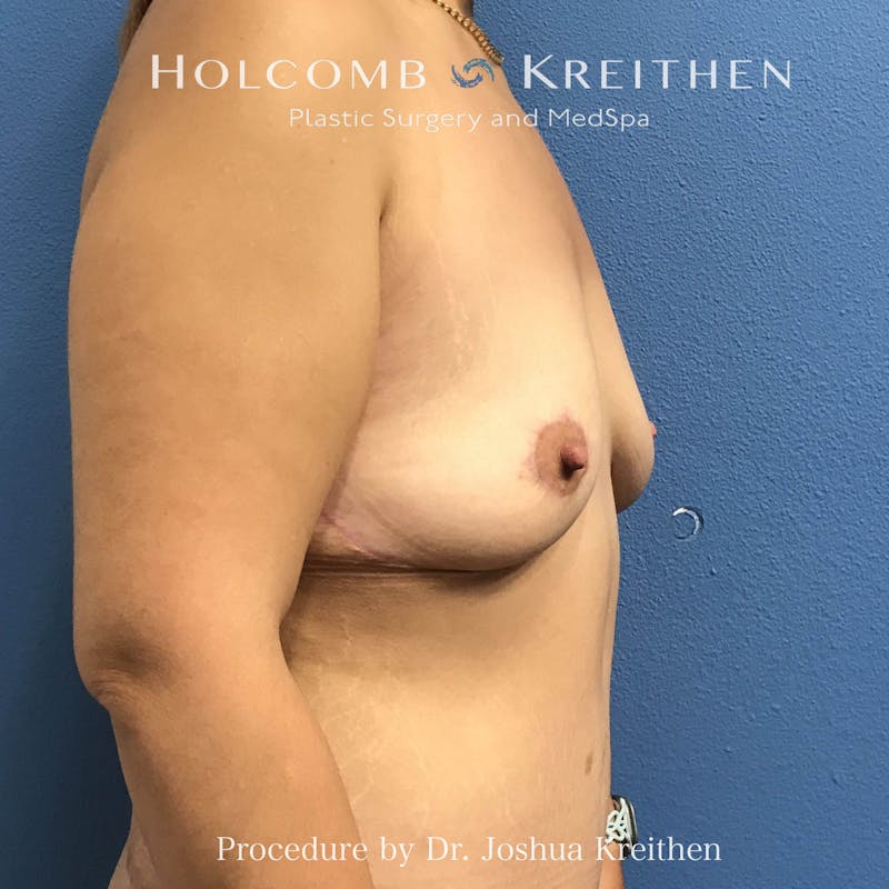 Breast Augmentation Before & After Gallery - Patient 378376 - Image 5