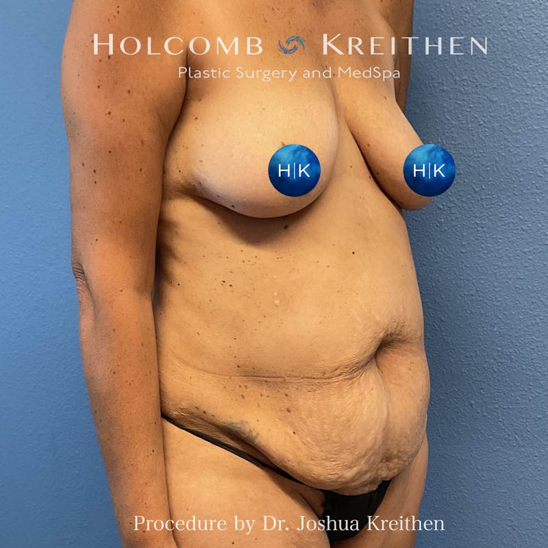 Tummy Tuck Before & After Gallery - Patient 123488 - Image 3