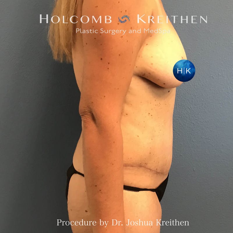 Tummy Tuck Before & After Gallery - Patient 123488 - Image 6